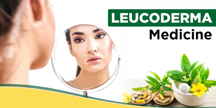leucoderma-medicine